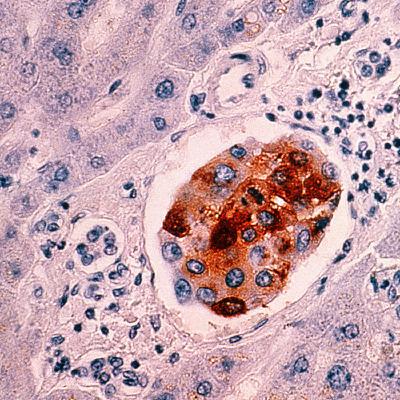 Century-old tumours could reveal why more young people are getting bowel cancer Century-old tumours could reveal why more young people are getting bowel cancer