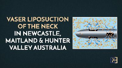Suction Assisted Lipectomy (VASER Liposuction) for the Neck with Dr. Beldholm | Everything You Need to Know