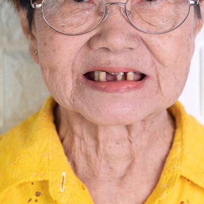 Audio Article: Longitudinal Look at Tooth Loss and Cognitive Decline among Older Adults