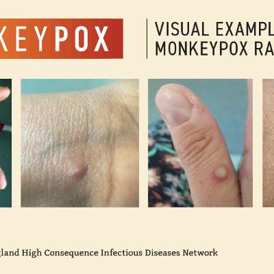 Monkey Pox Update