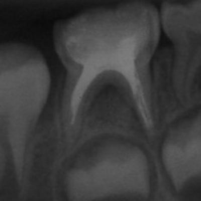 Pré-aula 13 - materiais obturadores de puloectomia em dentes decíduos