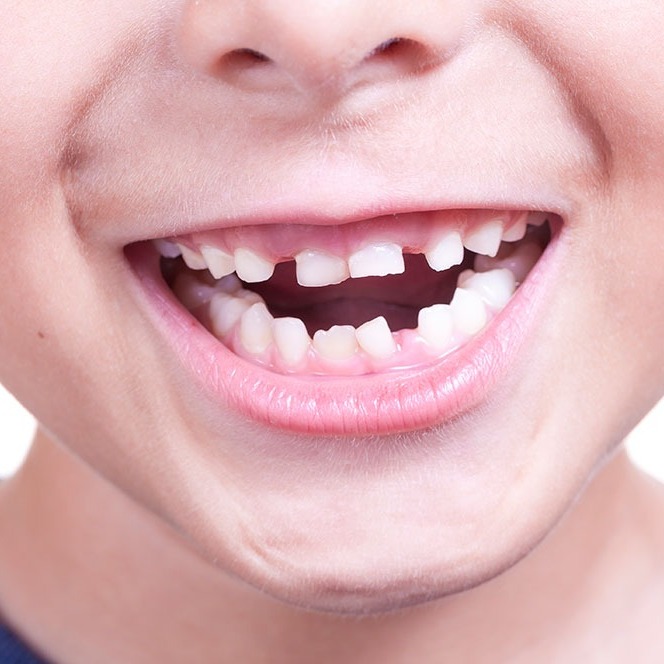 The OPTISMILE Podcast 92 - The Ugly Duckling Phase (Ages 6 to 12): Mixed Dentition The OPTISMILE Podcast 92 - The Ugly Duckling Phase (Ages 6 to 12): Mixed Dentition