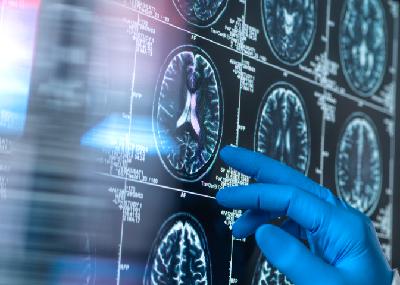 Cita prèvia amb el doctor Padrós -  Avenços per detectar l'Alzheimer i la longevitat