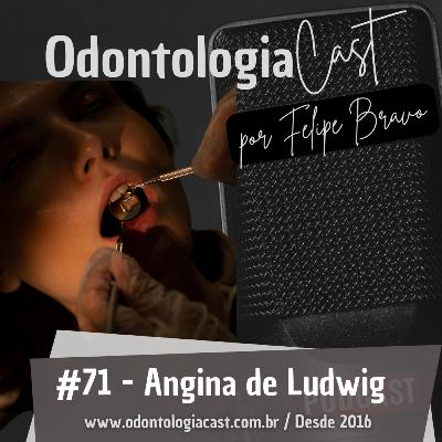 71 #Infecções Odontogênicas - Angina de Ludwig