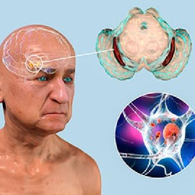 Avances en el tratamiento de la enfermedad de Hungtinton Avances en el tratamiento de la enfermedad de Hungtinton