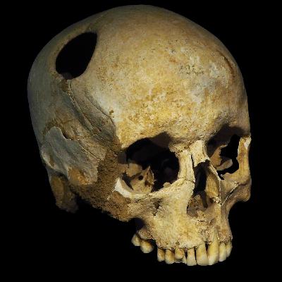 1. De las trepanaciones a la neurocirugía