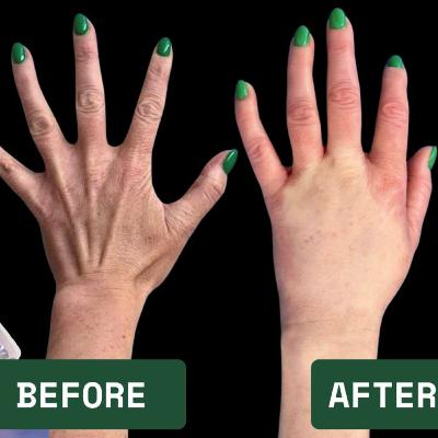 Fat Transfer to Hands (Podcast) - How It's Done