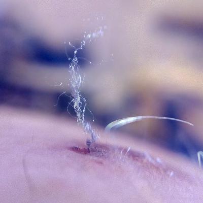 Morgellons News That Happened In August 2021