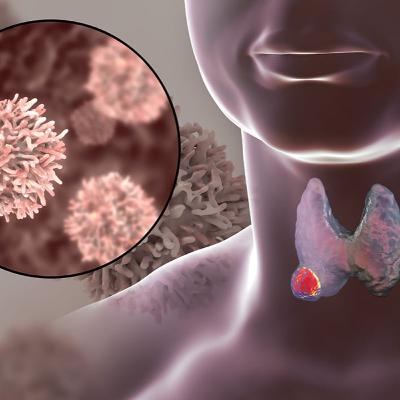 Audio Article: Thyroid Cancer - Hygienist Survives Surgery and Recommends Dental Monitoring for Symptoms