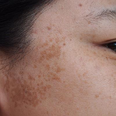 Episode #7 : Taches brunes, le guide complet anti-lentigos, mélasma et HPPI