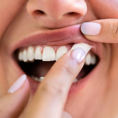 Audio Article: Systematic Review Evaluates the Oral Health Implications of Nicotine Pouch Use