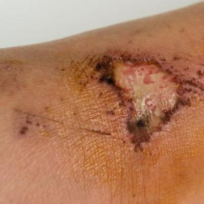 What Are The Top Causes of Delayed and Slow Healing Wounds on Body & Legs