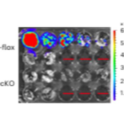 A lactate acetate interaction between  macrophages  and cancer  cells drives  metastasis