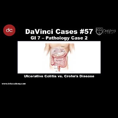 Ulcerative Colitis vs Crohn’s Disease [#DaVinciCases GI 7 - Pathology Case 2]