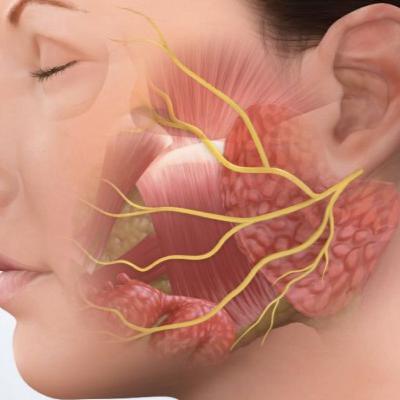 Paralisis Facial de Bell