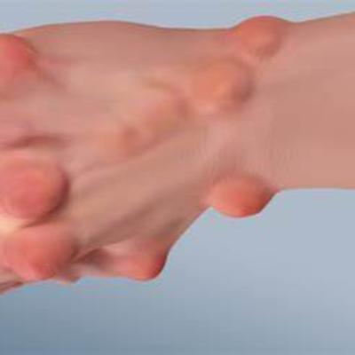What Is Rheumatoid Arthritis?