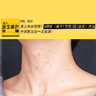 VOL.083身上长疣别懵！4种疣（扁平|寻常|跖|丝状）咋治？中西医治法一次说清！