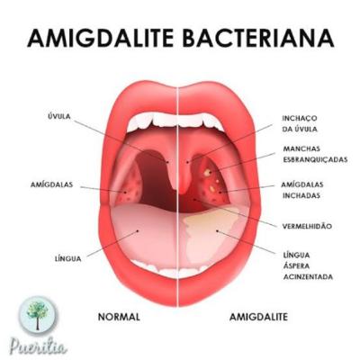 Amidalite