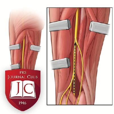 "Extended Sural Nerve Harvest" with Shai Rozen, MD - Jan. 2026 Journal Club "Extended Sural Nerve Harvest" with Shai Rozen, MD - Jan. 2026 Journal Club