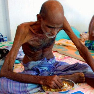 Impacto de la desnutrición