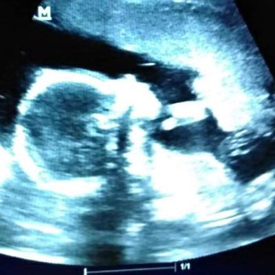 Your Pregnant !