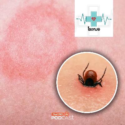 โรงหมอ EP. 1170: "ไลม์" โรคจากเห็บ เป็นแล้วเหมือนไม่มีอะไร ไม่รักษาเสี่ยงตายได้ โรงหมอ EP. 1170: "ไลม์" โรคจากเห็บ เป็นแล้วเหมือนไม่มีอะไร ไม่รักษาเสี่ยงตายได้