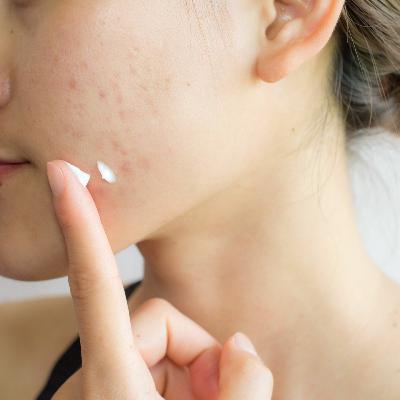 Doctors: How To Treat Teen Acne
