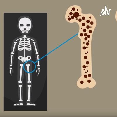 Osteoporosis