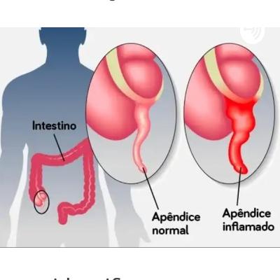 Apendicite