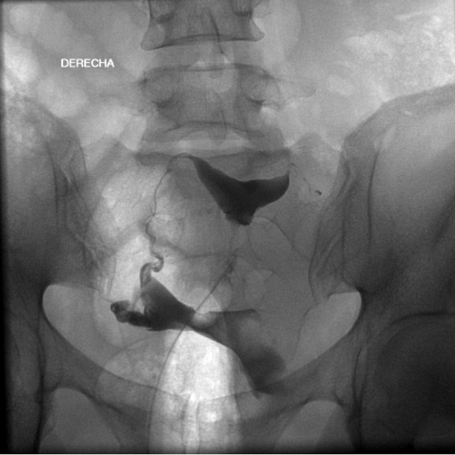Histerosalpingografía - ¿Tienes las trompas obstruidas?