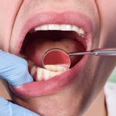 Tudo sobre cáries e prevenção Tudo sobre cáries e prevenção