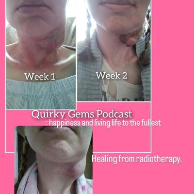 Healing from radiotherapy