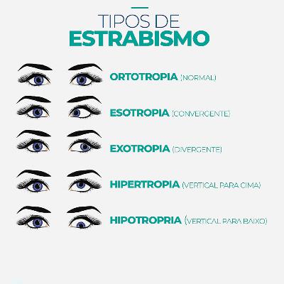Classificação e tipos do Estrabismo