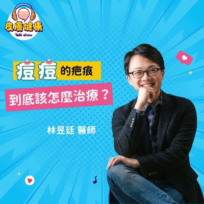 EP12｜痘痘的疤痕到底該怎麼治療？林昱廷醫師