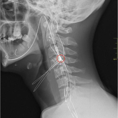 A Nervous Tick | SCP-8891 | SAFE