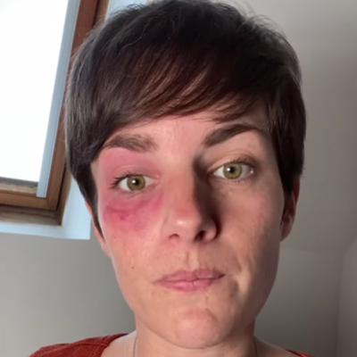 ATTEINTE D'ALGIE VASCULAIRE DE LA FACE, DIANE TÉMOIGNE