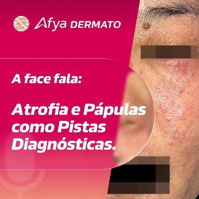 A face fala: atrofia e pápulas como pistas diagnósticas A face fala: atrofia e pápulas como pistas diagnósticas