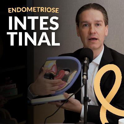Endometriose Intestinal | #5