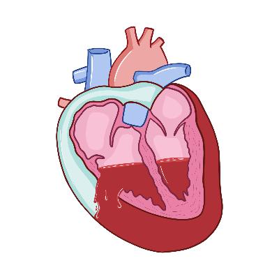 431. Cardiac Tamponade