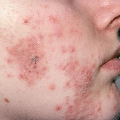 Isotretinoina: roacutan experiencia y conclusiones