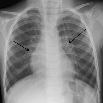 Ep 73: How to deal with RSV infections! Ep 73: How to deal with RSV infections!