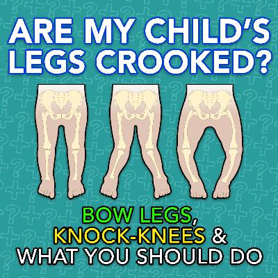 Are My Child's Legs Crooked? Bow Legs, Knock-Knees & What You Should Do