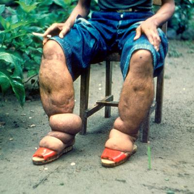 ID4U Episode 17 Lymphatic Filariasis
