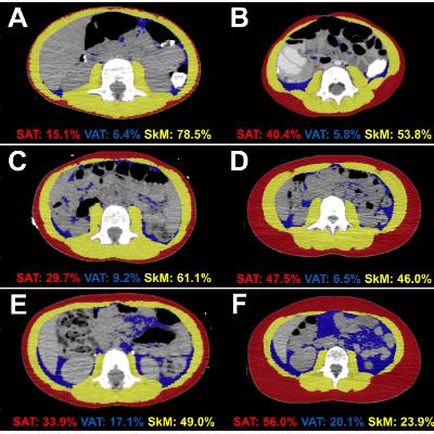 Unmasking the Hidden Shifts: Why Your BMI Doesn't Tell the Whole Story in Pediatric Cancer Treatment