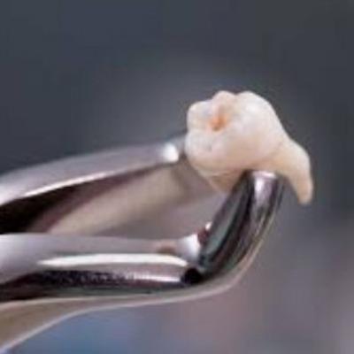 Pré-aula 4 - Necessidade e oportunidade da cirurgia em odontopediatria