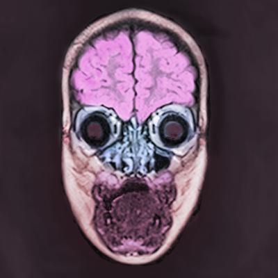 A Discussion On Over-The-Counter Cough Syrup Misuse