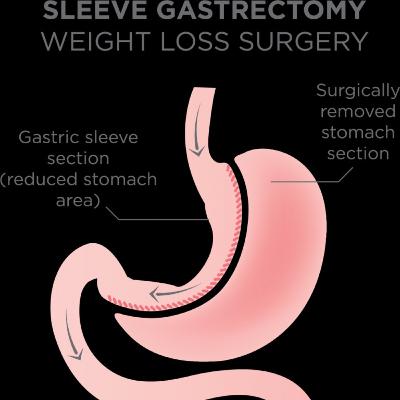 Bariatric Surgery aka Weight Loss Surgery