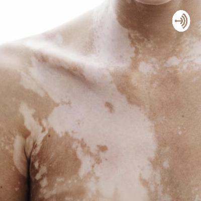 Let’s talk Vitiligo (Trailer) Let’s talk Vitiligo (Trailer)
