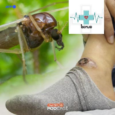 โรงหมอ EP. 1144: ริ้นฝอยทราย ตัวเล็กแต่ร้าย โดนกัดแล้วอาจตายได้ โรงหมอ EP. 1144: ริ้นฝอยทราย ตัวเล็กแต่ร้าย โดนกัดแล้วอาจตายได้