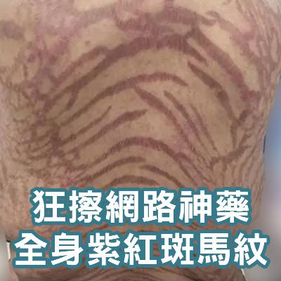 【S2 EP.116】狂擦網路爆紅神藥，反而導致全身紫紅斑馬狀。